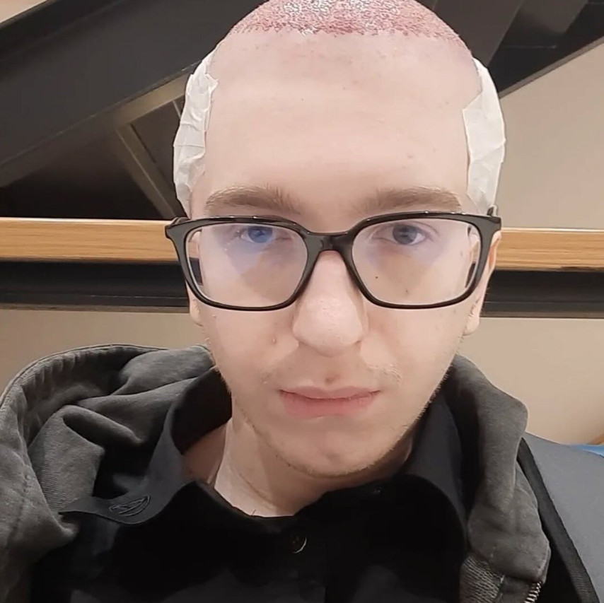 Save after hair transplant surgery